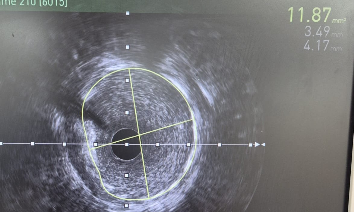 Angioplastia Complexa de Bifurcação ADA × Ramo Diagonal